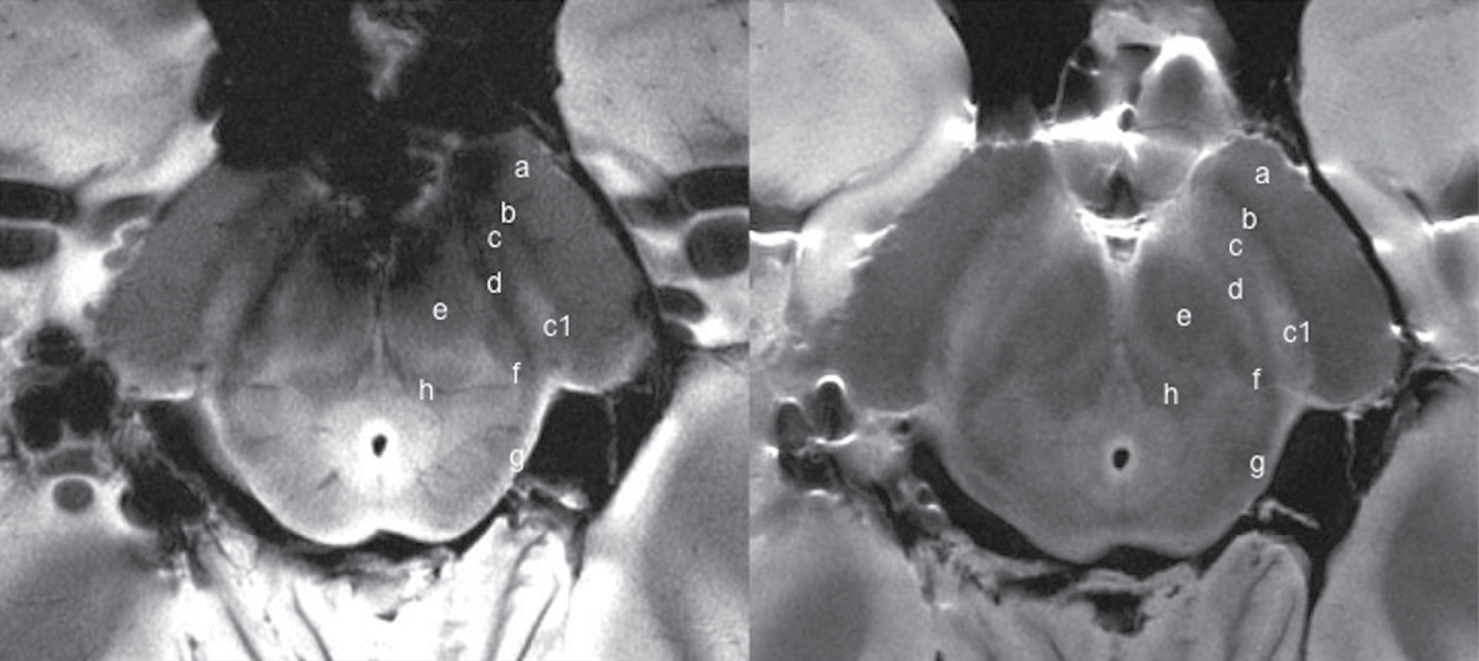 Transverse gadolinium-enhanced T1-weighted MR images obtained superior to the carotid artery bifurcation
